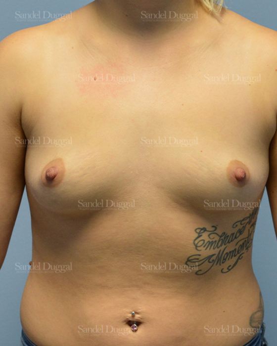 Breast Augmentation before, case 3101