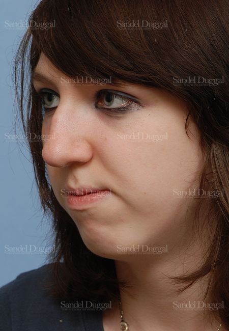 Rhinoplasty before, case 2826