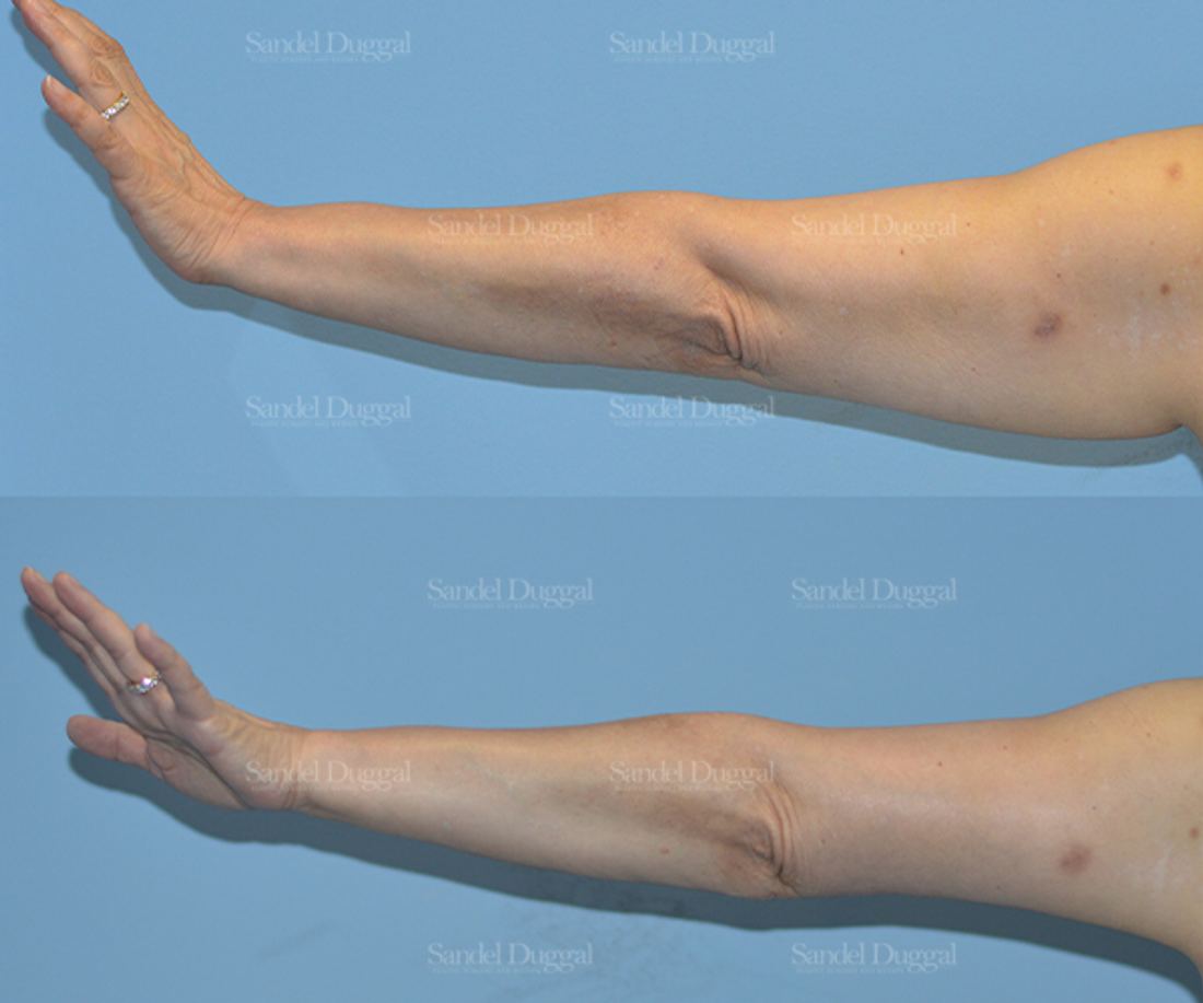 Brachioplasty before and after, case 2103