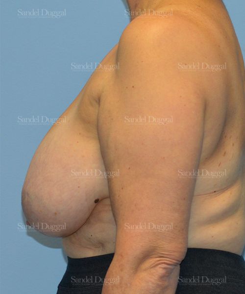 Breast Lift before, case 3287