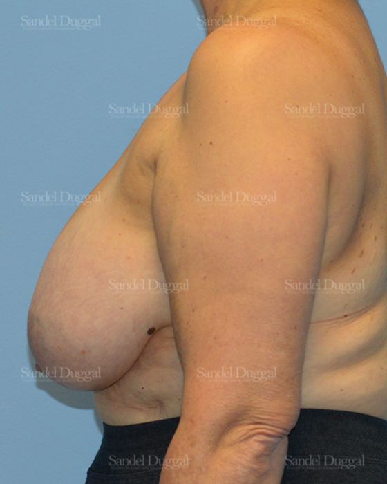 Breast Lift before, case 3287