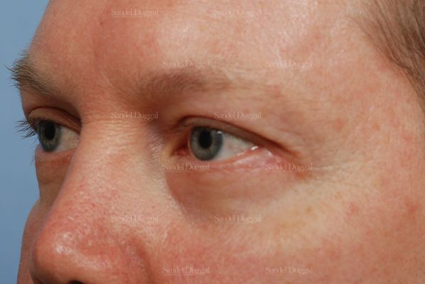 Eyelid Rejuvenation after, case 1965