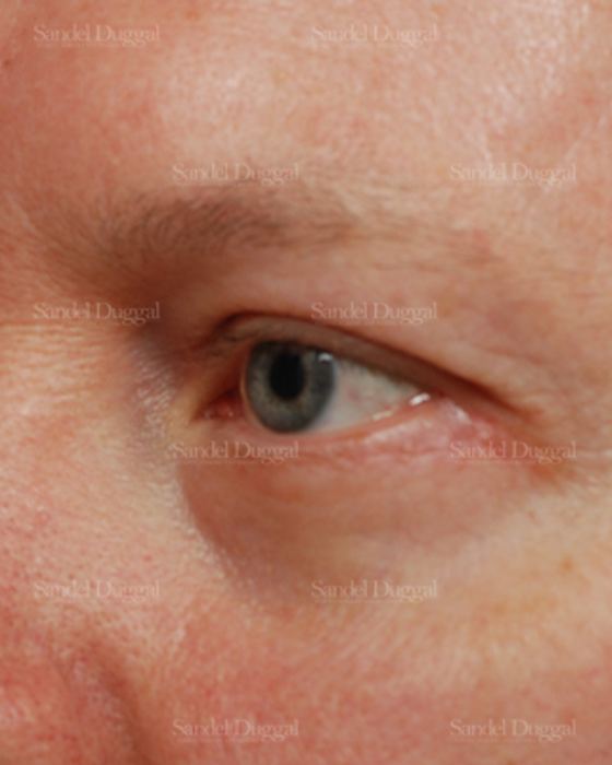 Eyelid Rejuvenation after, case 1965