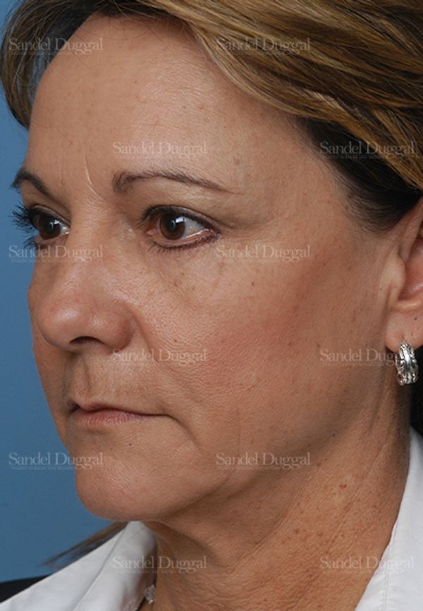 Laser Skin Resurfacing after, case 2935