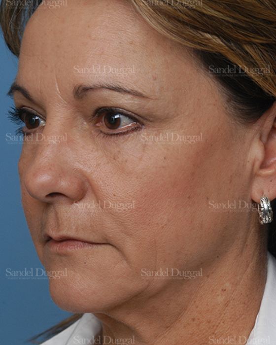 Laser Skin Resurfacing after, case 2935