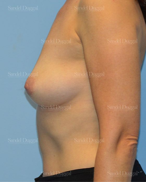 Breast Augmentation before, case 3108