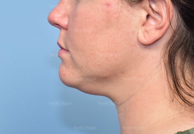 Neck & Chin Liposuction before, case 5359