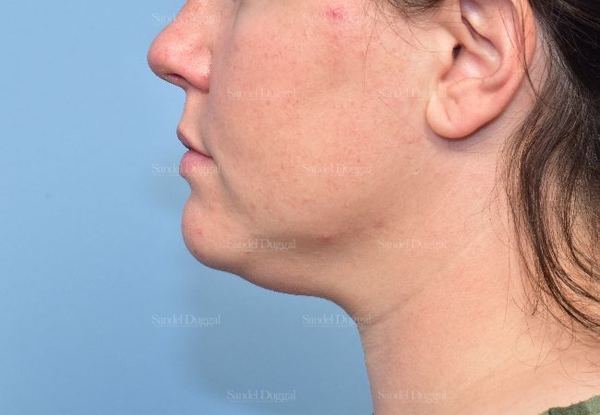 Neck & Chin Liposuction before, case 5359