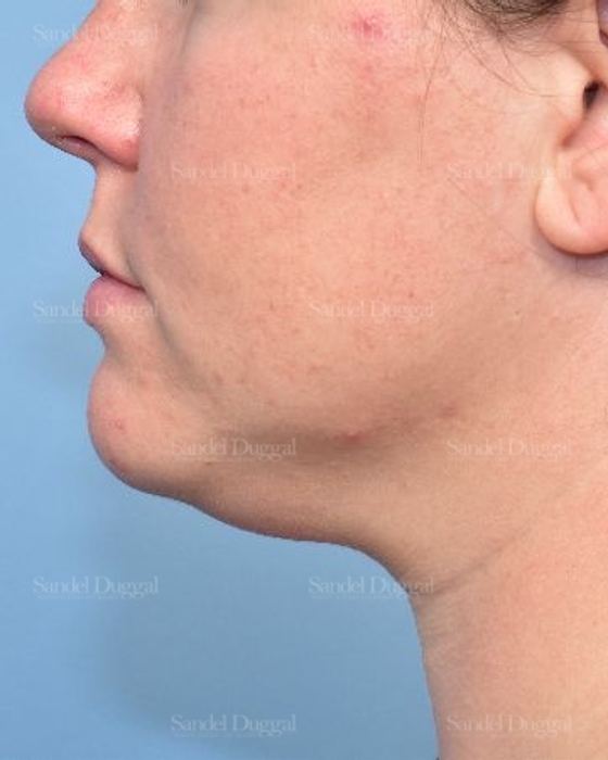 Neck & Chin Liposuction before, case 5359