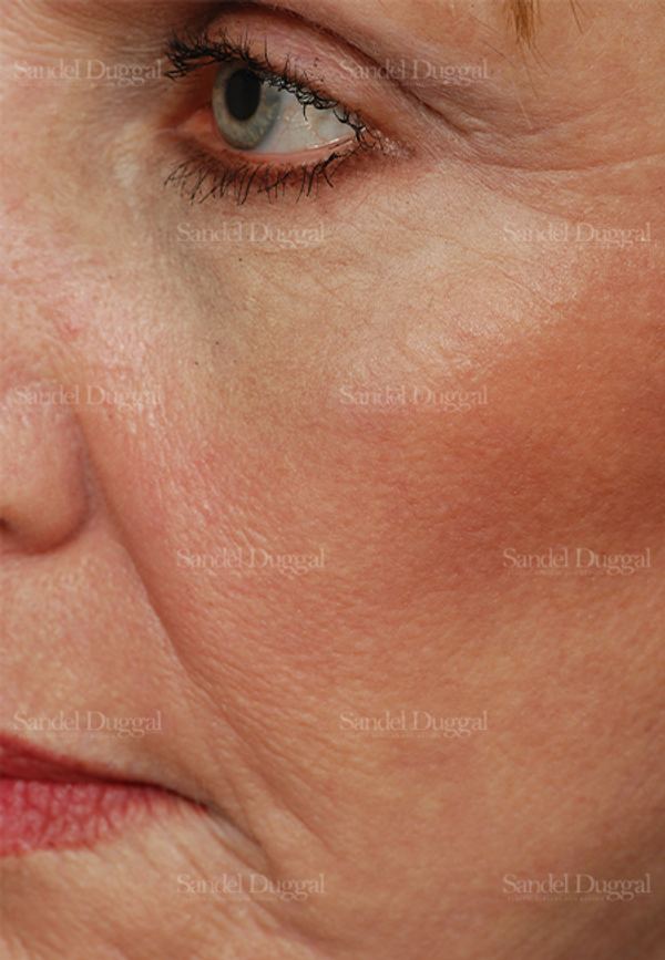 Laser Skin Resurfacing after, case 2938