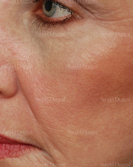 Laser Skin Resurfacing after, case 2938