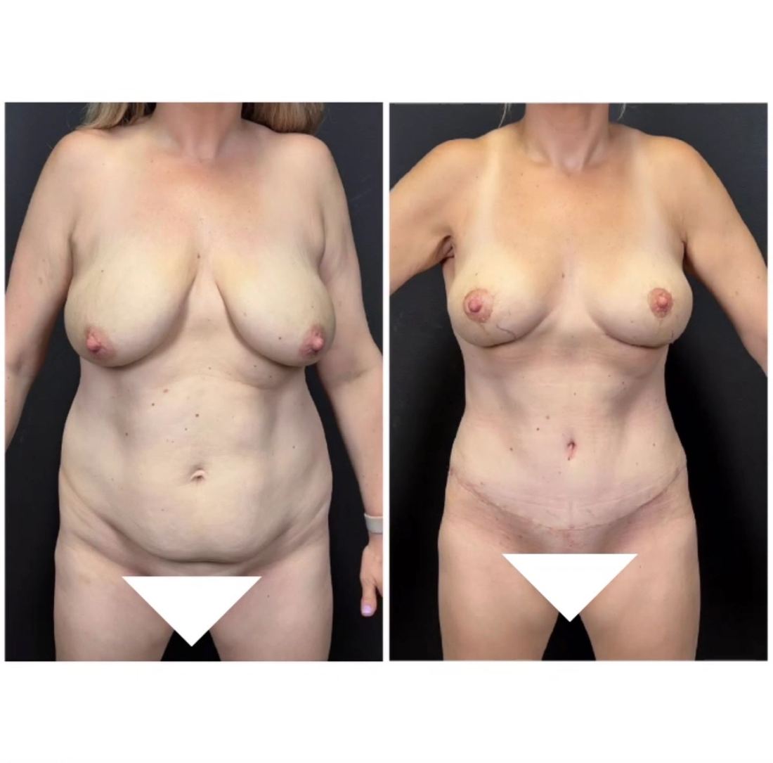 Mommy Makeover before and after, case mommy-makeover-09