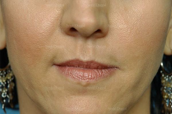 Botox & Fillers after, case 2585