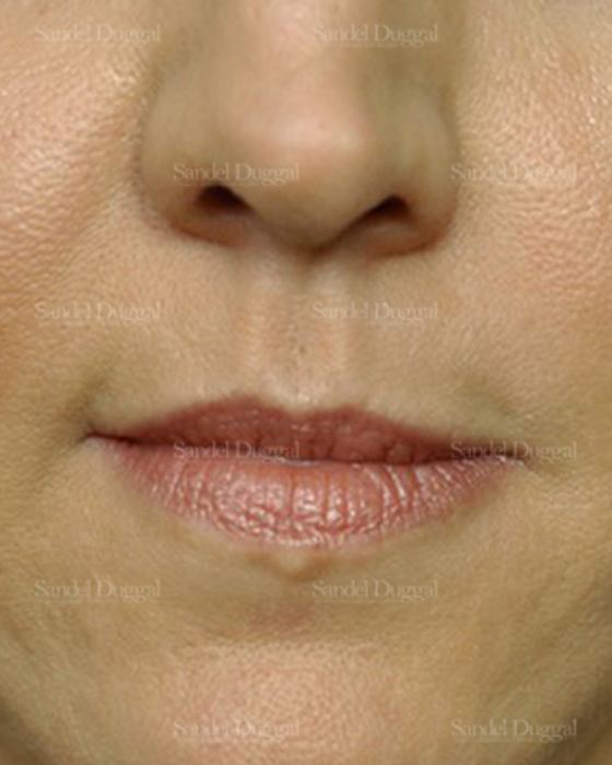 Botox & Fillers after, case 2585