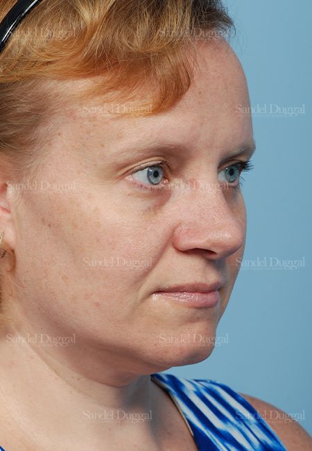 Rhinoplasty after, case 2862