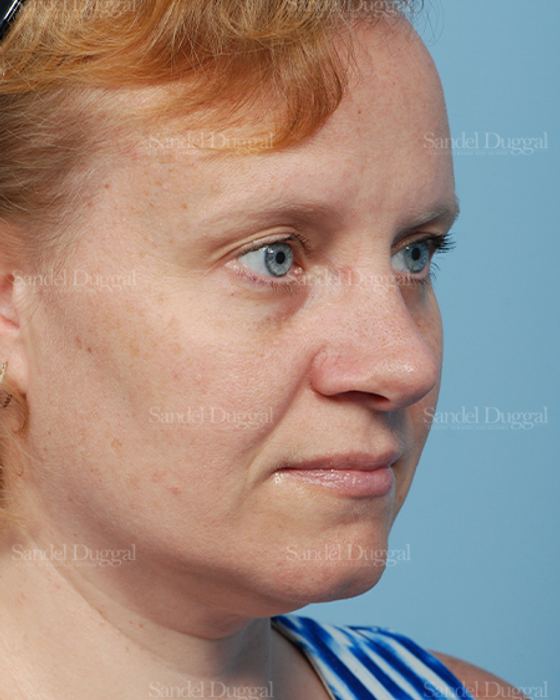 Rhinoplasty after, case 2862