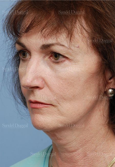 Cheek Augmentation before, case 1427