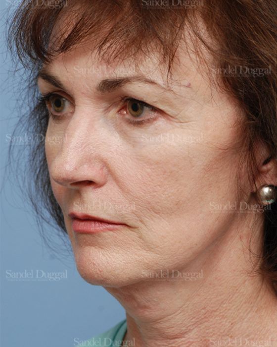Cheek Augmentation before, case 1427