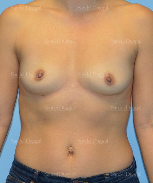 Breast Augmentation before, case 3234