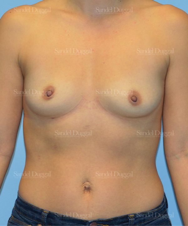 Breast Augmentation before, case 3234