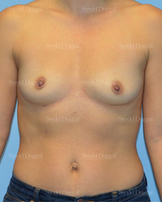 Breast Augmentation before, case 3234