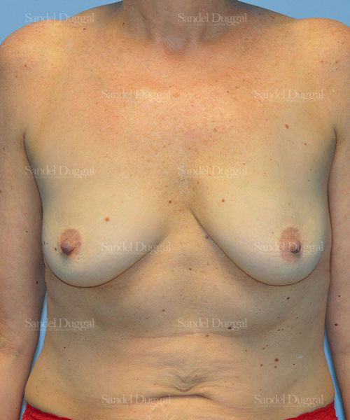 Breast Augmentation with Lift before, case 3414