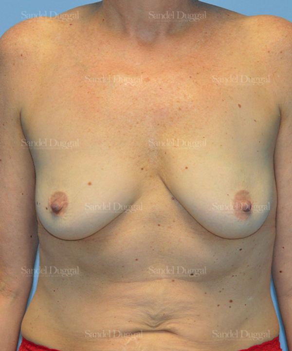 Breast Augmentation with Lift before, case 3414