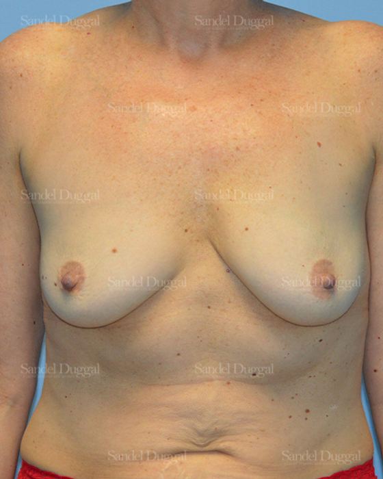 Breast Augmentation with Lift before, case 3414
