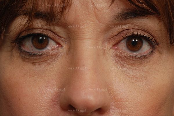 Eyelid Rejuvenation after, case 831