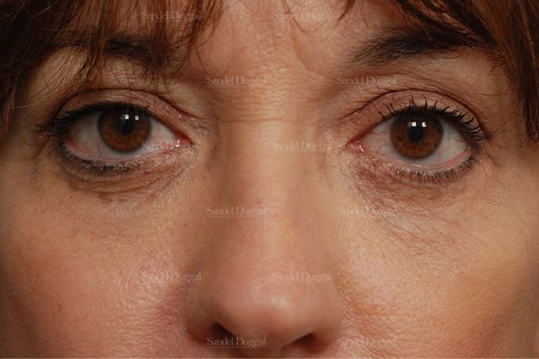 Eyelid Rejuvenation after, case 831