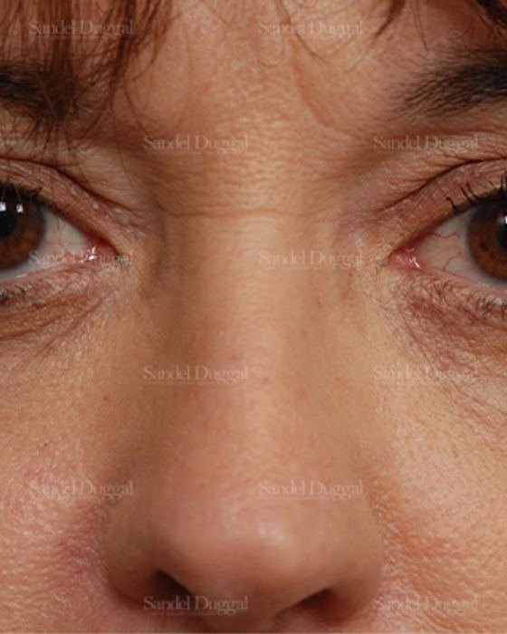 Eyelid Rejuvenation after, case 831
