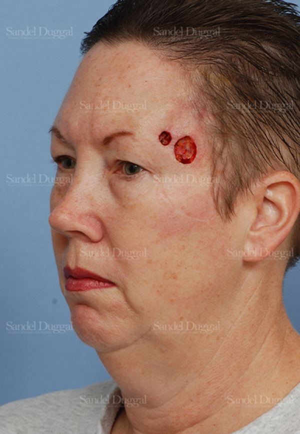 Reconstruction after Mohs before, case 2754