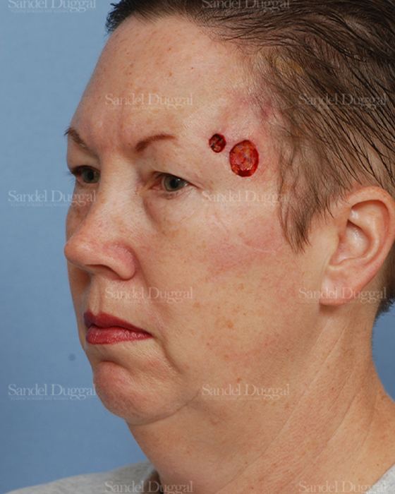 Reconstruction after Mohs before, case 2754