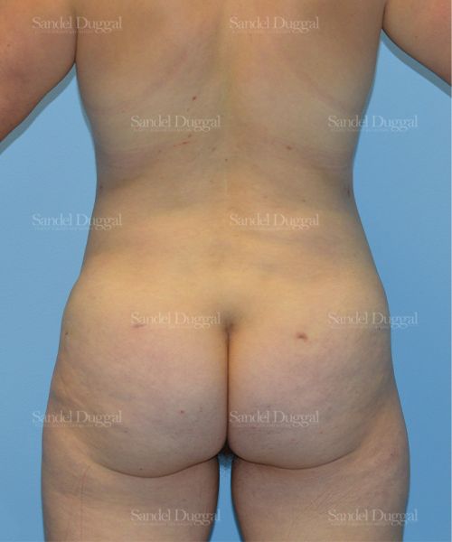 Liposuction — Legs & Flanks after, case 2512
