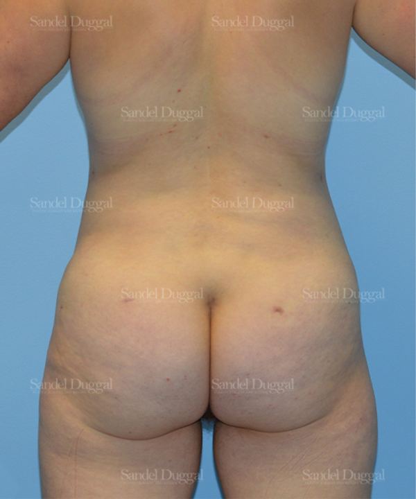 Liposuction — Legs & Flanks after, case 2512