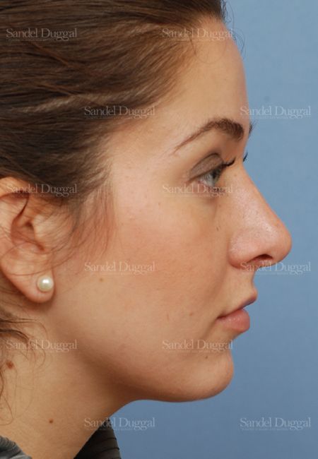 Rhinoplasty after, case 2894