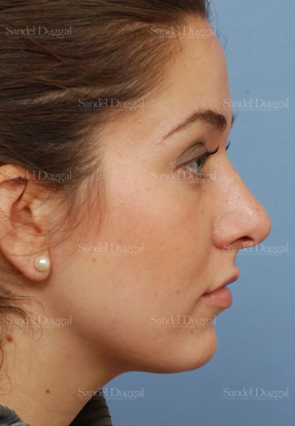 Rhinoplasty after, case 2894