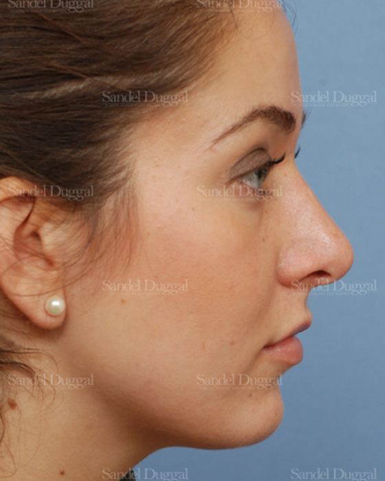 Rhinoplasty after, case 2894