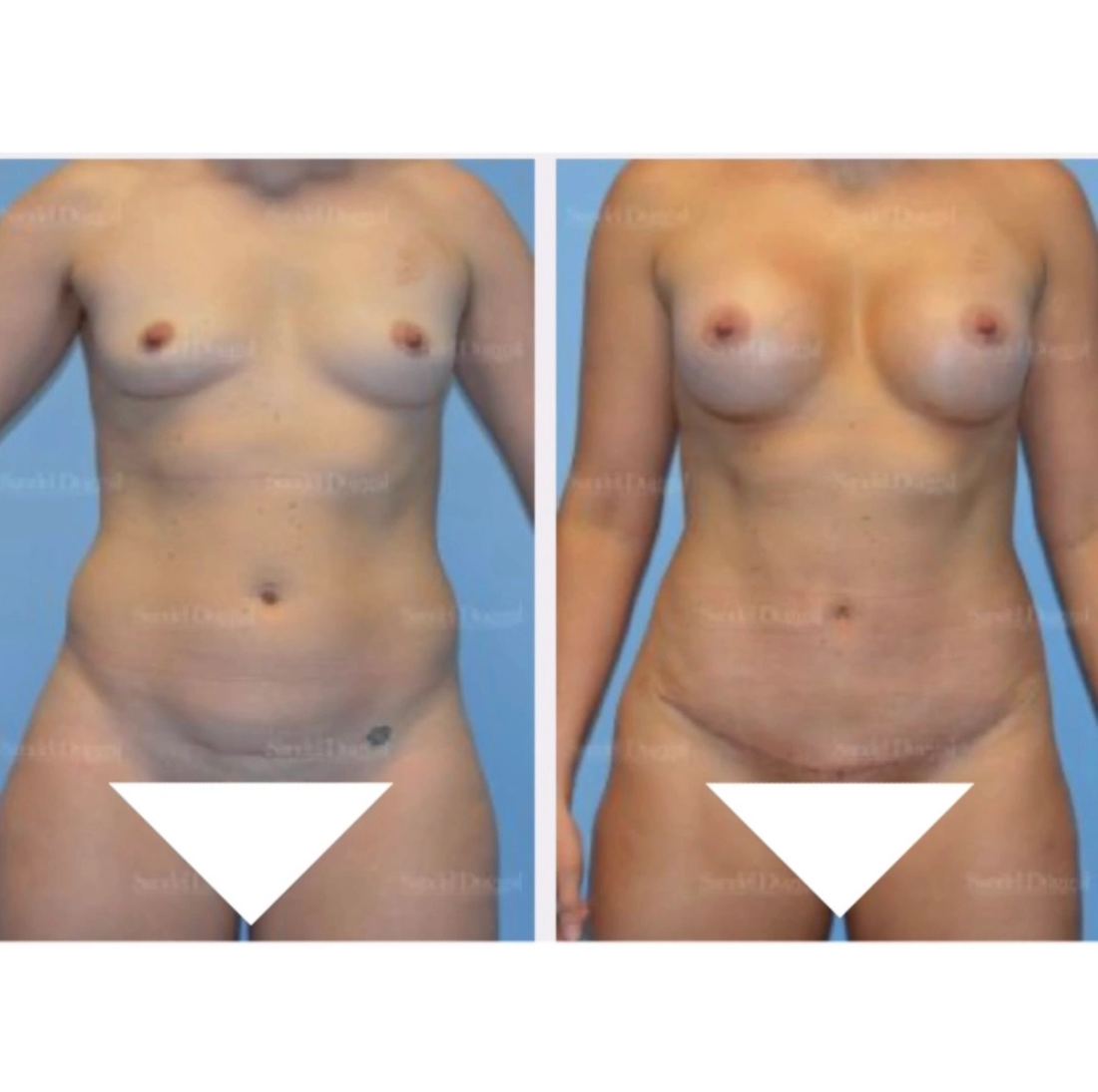 Mommy Makeover before and after, case mommy-makeover-13