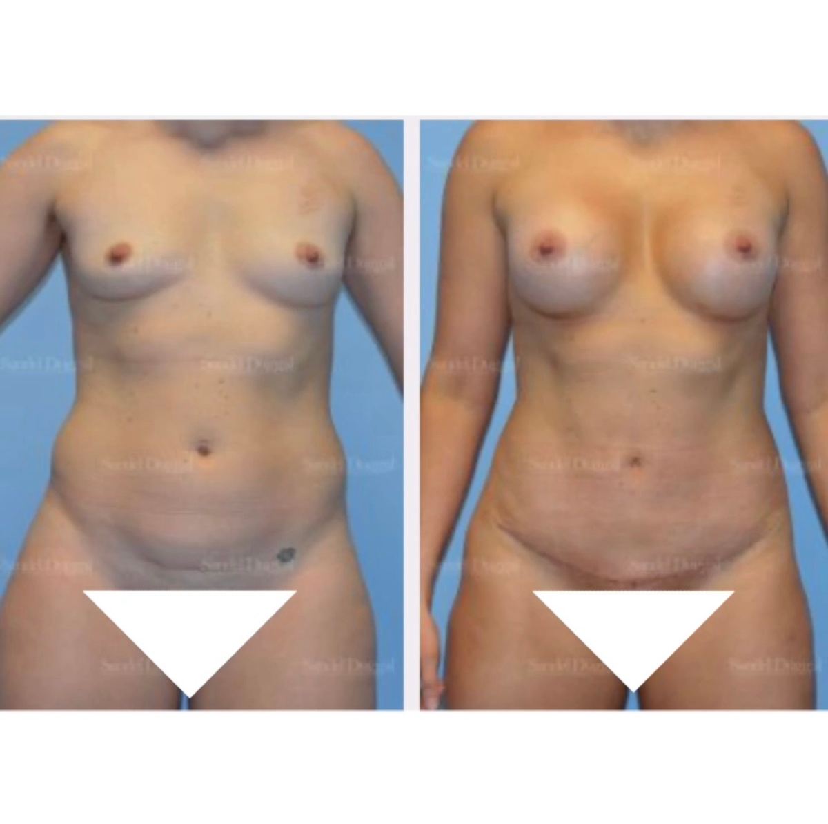 Mommy Makeover before and after