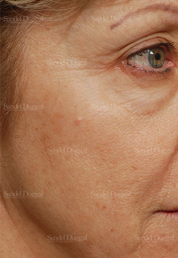 Laser Skin Resurfacing before, case 2944