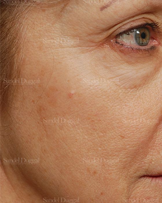 Laser Skin Resurfacing before, case 2944