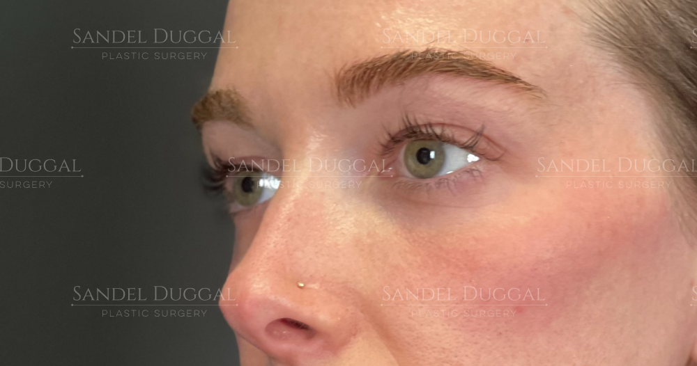 Eyelid Rejuvenation before, case 6001