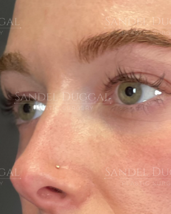 Eyelid Rejuvenation before, case 6001