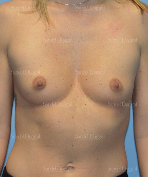Breast Augmentation before, case 3171