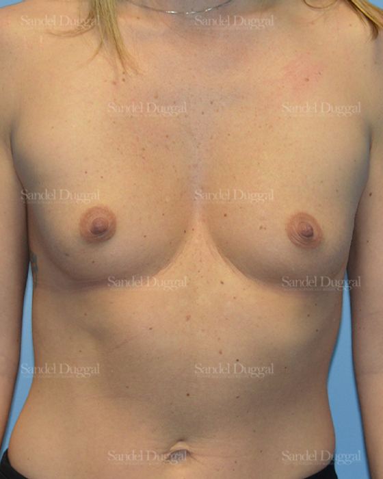Breast Augmentation before, case 3171