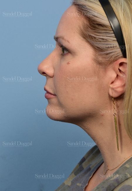 Neck & Chin Liposuction before, case 5315