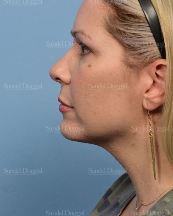 Neck & Chin Liposuction before, case 5315