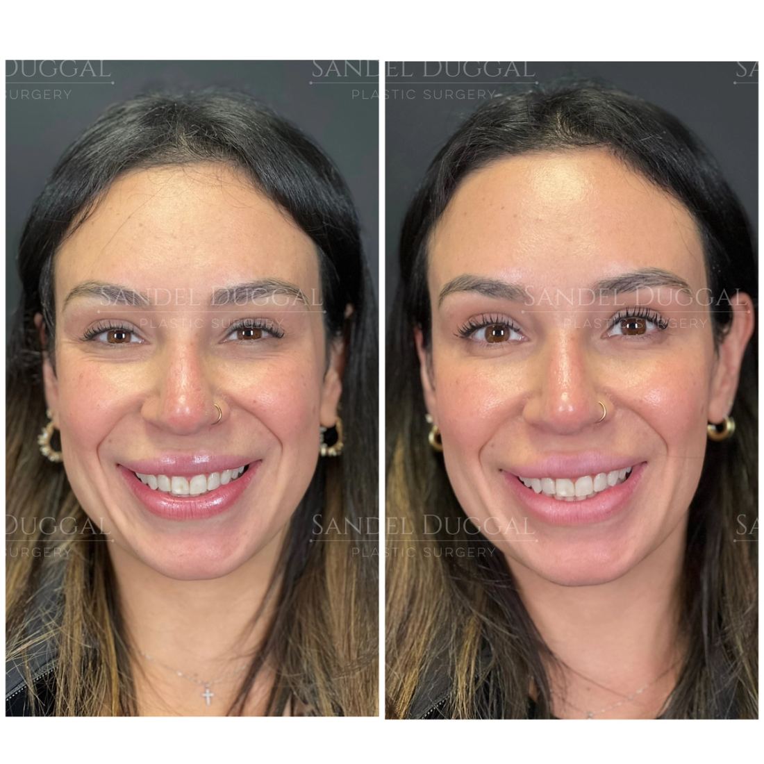 Botox & Fillers before and after, case 6013