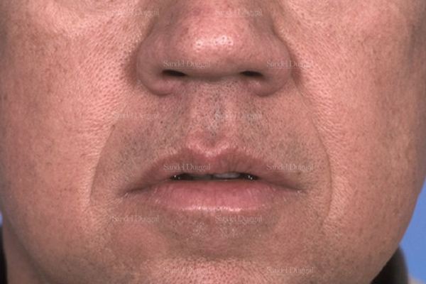 Botox & Fillers before, case 2591